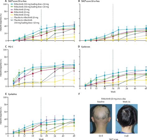 Efficacy And Safety Of Ritlecitinib In Adults And Adolescents With Alopecia Areata A Randomised
