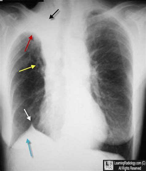 Learning Radiology Atelectasis Right Upper Lobe Rul
