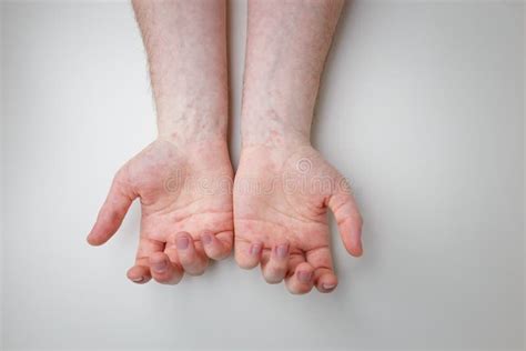 Patient Showing Red Itchy Rash On Hands And Arms Dermatitis Eczema