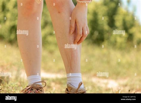 A Woman Scratches Her Legs With Redness And Irritation From Insect