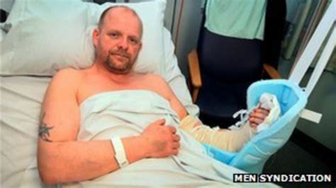 Surgeons Save Mans Arm Cut Off In Saw Accident Bbc News