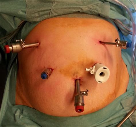 Simplified Laparoscopic Hill Repair For The Treatment Of Symptomatic
