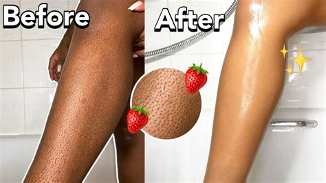 How To Get Rid Of Strawberry Legs In One Day‼️get Rid Of Dark Spots And
