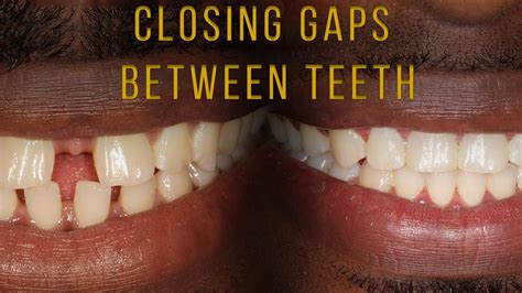 Closing Gaps Between Teeth With Braces Youtube