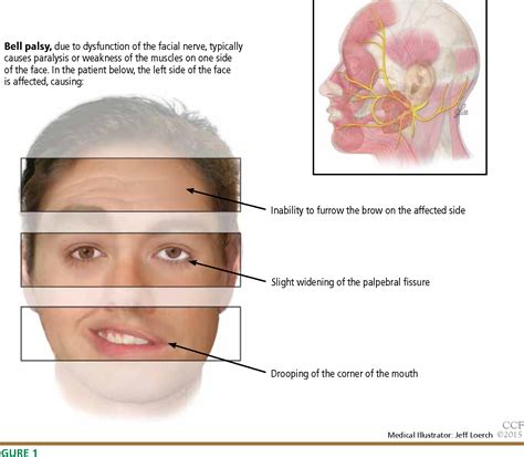 Bell S Palsy Bell S Palsy Disease Reference Guide Drugs