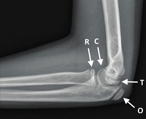 Developmental Morphology Of The Elbow Joint In Relation To Injuries Of