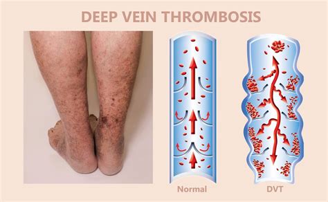How Do You Know If You Have Deep Vein Thrombosis Dvt Vein