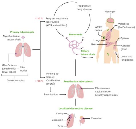 Tuberculosis Concise Medical Knowledge