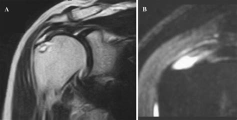 A Intratendinous Tear Of The Supraspinatus With A Subchondral Cyst And