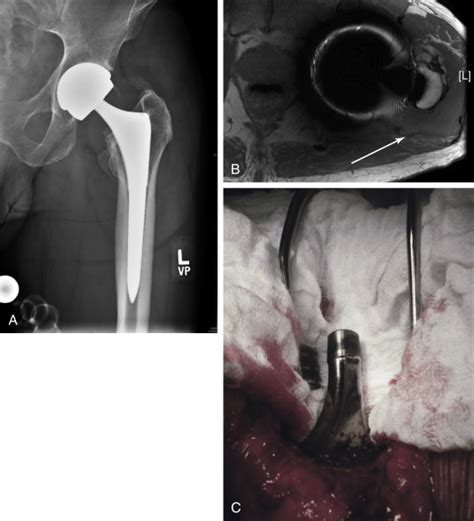 Mechanisms Of Failure Indications For Revision Total Hip Arthroplasty
