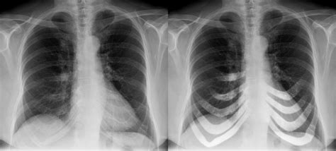 Chest X Ray Anatomical Variants Costochondral Calcification