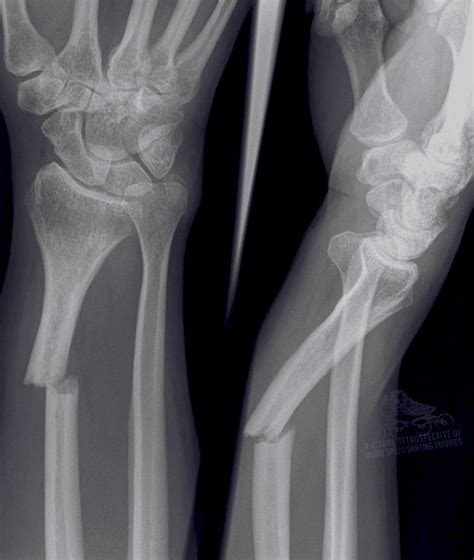Stephen Hawking Greys Anatomy Calliope Torres Broken Wrist X Ray