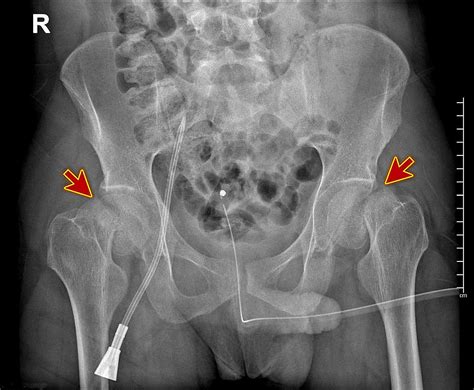 Femur Fractures Radiology My Xxx Hot Girl