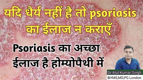 Psoriasis Treatment Psoriaisis Skin Disease Psoriasis Scalp Removal
