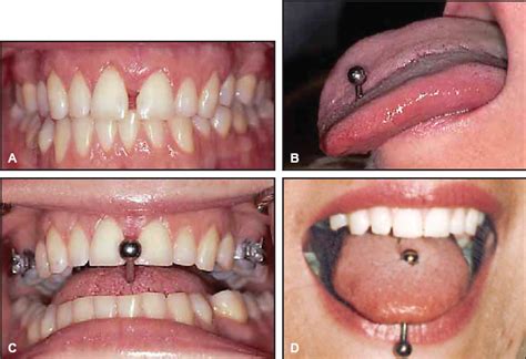 Midline Diastema Caused By Tongue Piercing Jco Online Journal Of