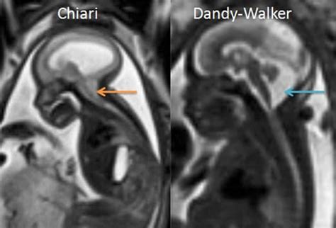 Developmental Anomalies To Watch Out For Chiari And Dandy Walker Syndromes