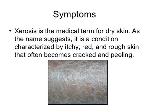 Dr Ajays Homeopathy Homeopathy For Xerosis Of The Skin Dry Skin