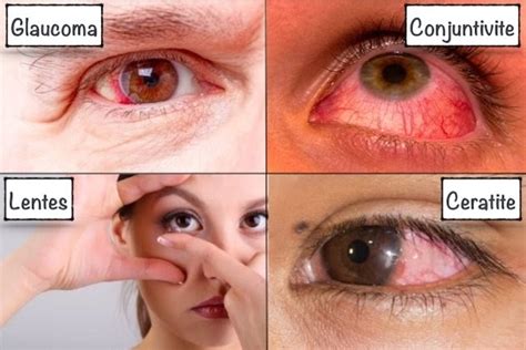 Dor De Cabeça Atras Dos Olhos E Febre Sobre Os Olhos