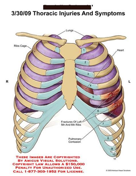 Heart attack causes a sudden pain of various intensity behind the breastbone or slightly to the left. lungs in ribs - Google Search | anatomy | Pinterest | Ribs ...
