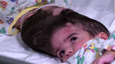 Babes Conjoined At The Head Are Separated After Hours Of Surgery CNN