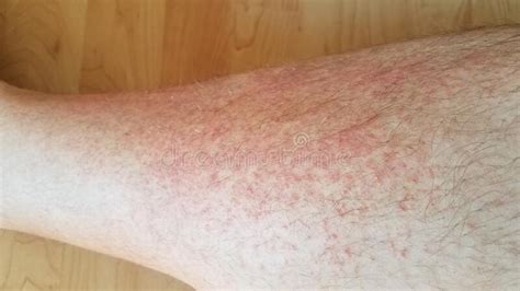 Red Rash Or Inflammation On Male Leg Stock Photo Image Of Itchy