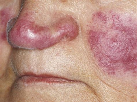 Bene, sei arrivato al miglior sito dedicato a questo gioco. Cos'è il lupus: sintomi e cura della malattia autoimmune