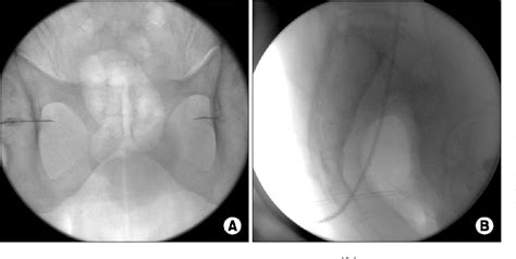 Figure 1 From Fluoroscopy Guided Pudendal Nerve Block And Pulsed
