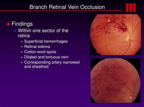 Ppt Arterial And Venous Occlusive Disease Of The Retina Powerpoint