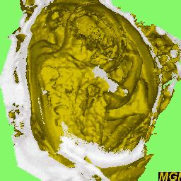 Visible Fetus With MRI 3D 4D Imaging UCL
