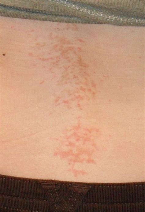 Lower Back Rash Pictures Photos