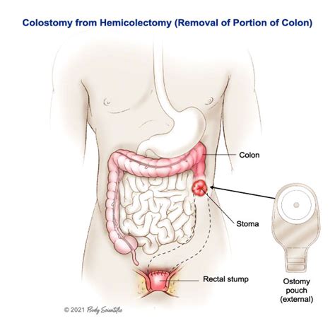 Proctocolectomy Hemicolectomy Resection L United Ostomy Associations Of America