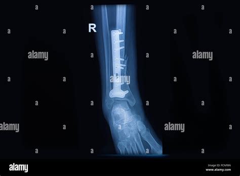 Distal Fibula Fracture Hi Res Stock Photography And Images Alamy