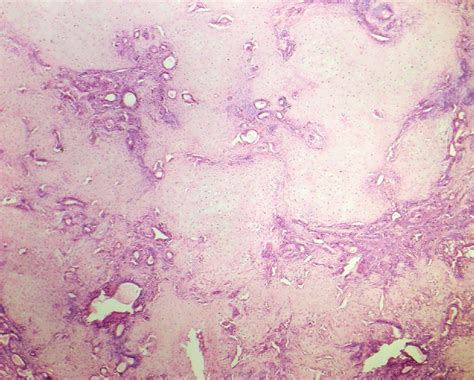 Pleomorphic Adenoma Of The Cheek A Case Report And Review Journal Of