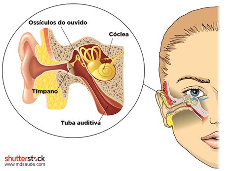 Zumbido No Ouvido Acufeno E Tinido Causas E Tratamento