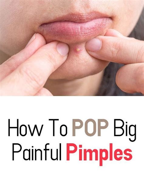 How To Pop Big Painful Pimples Painful Pimple Pimples Skin Ulcer