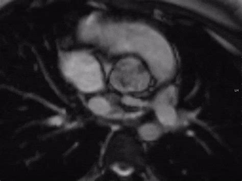 Cardiac Mri Of Unicuspid Unicommissural Aortic Valve Grepmed