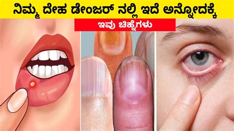 20 Signs Your Body Is Asking For Help Vitamins Deficiency Signs Kannada Youtube