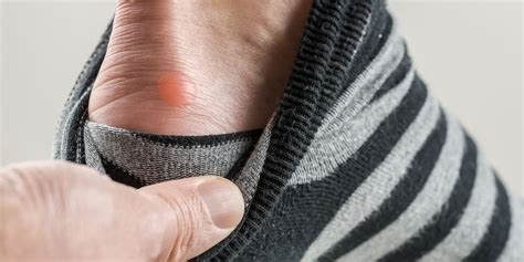 Blister Treatment How To Get Rid Of A Blister