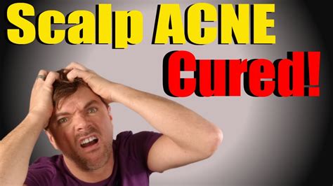 Scalp Acne Cure My Expert Tips To Get You Clear Fast Chris Gibson