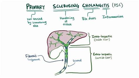 Primary Sclerosing Cholangitis Medizzy