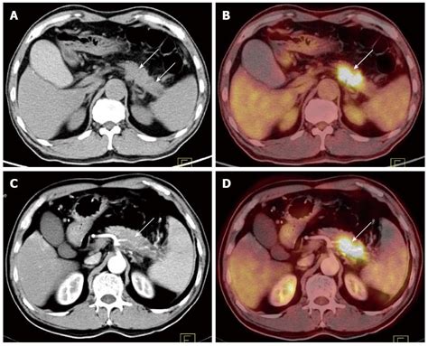 Cross Modality Petct And Contrast Enhanced Ct Imaging For Pancreatic