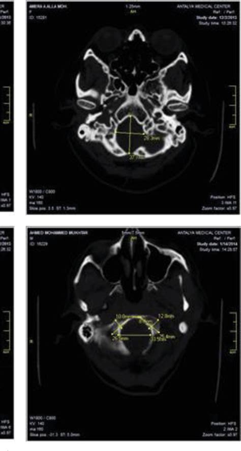 figure 1 from sex prediction using foramen magnum and occipital condyles computed tomography