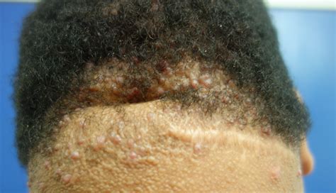 Acne Keloidalis Nuchae Osei Tutu Dermatology And Hair Restoration