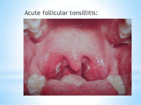 Acute Tonsillitis