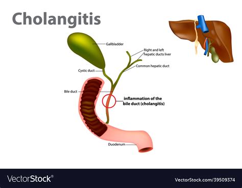 Ascending Cholangitis Also Known As Acute Vector Image