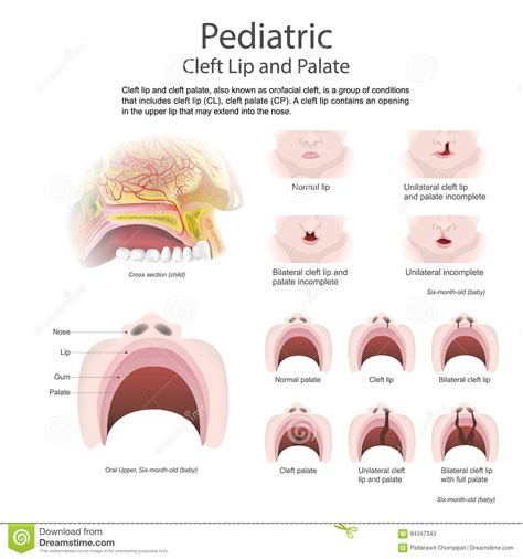 Cleft Lip And Cleft Palate Vector Art Illustration Stock Vector