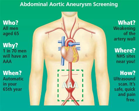 Abdominal Aortic Aneurysm Screening Ourgateshead