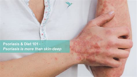Psoriasis And Diet 101 Psoriasis Is More Than Skin Deep Tash360