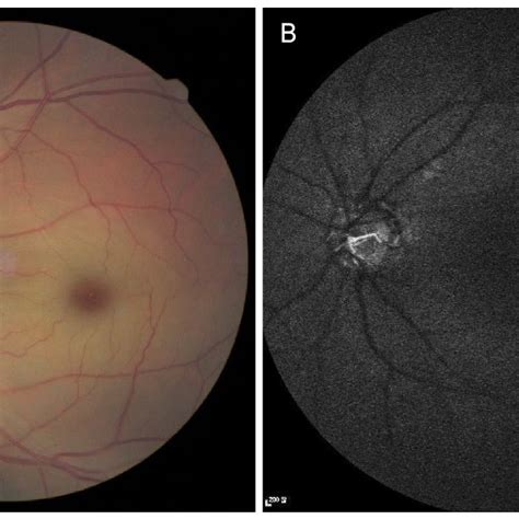 Fundus Photography And Fluorescein Angiography Of Case 1 A Fundus