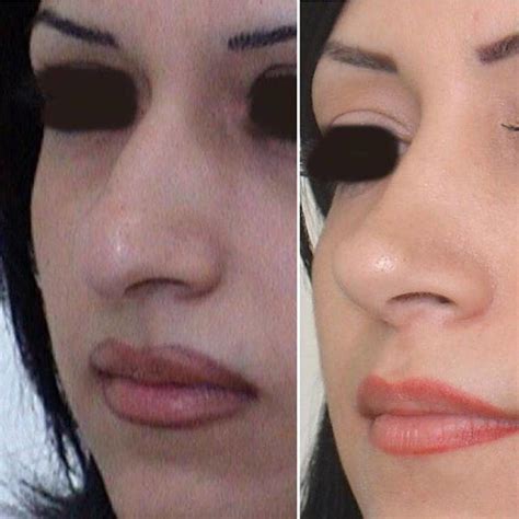 Septoplasty Photo Before And After 2 Rhinoplasty Cost Pics